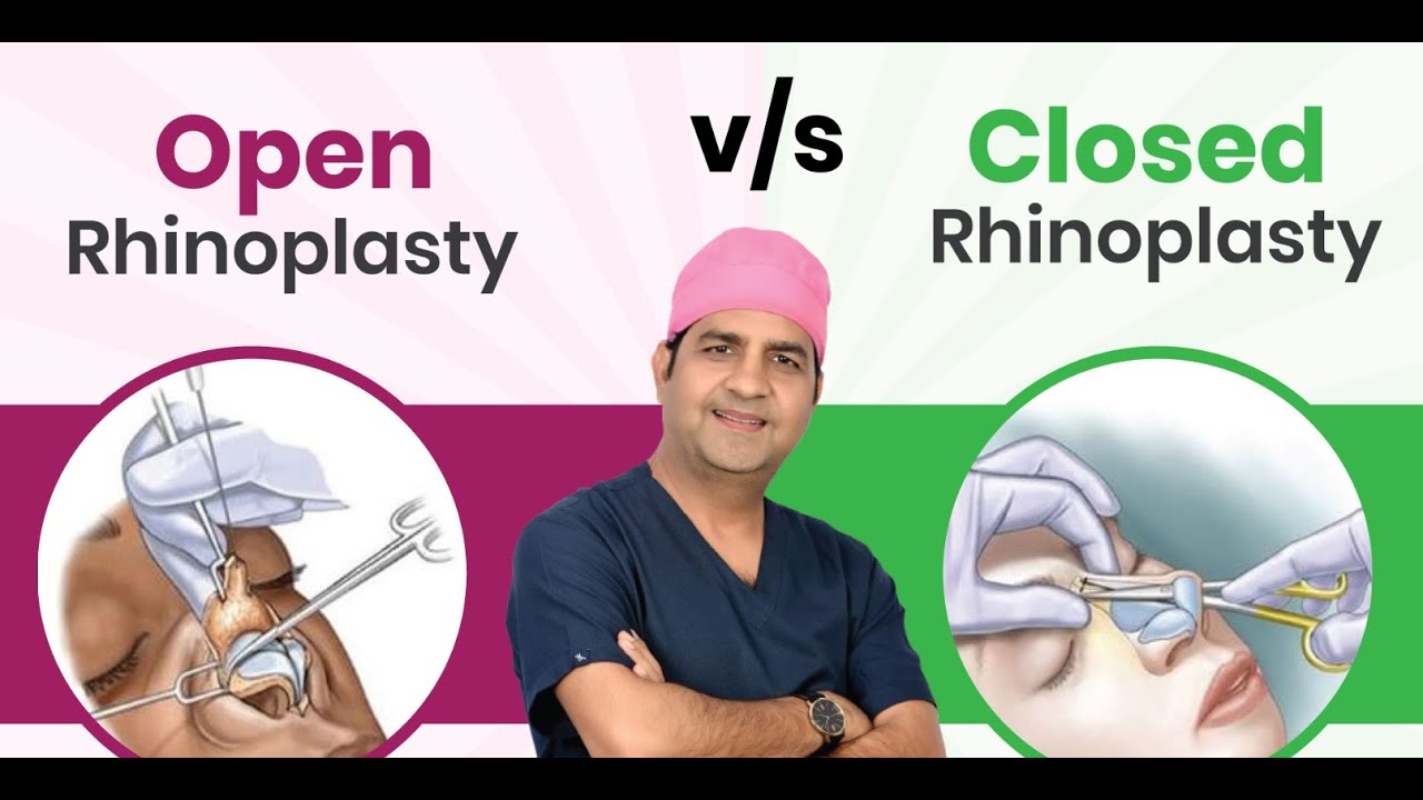 OPEN vs CLOSED Rhinoplasty: Which One Is BEST For You?