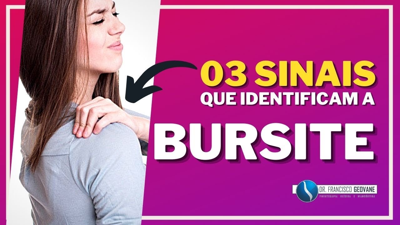 Subacromial subdeltoid bursitis - 3 signs that identify shoulder bursitis.