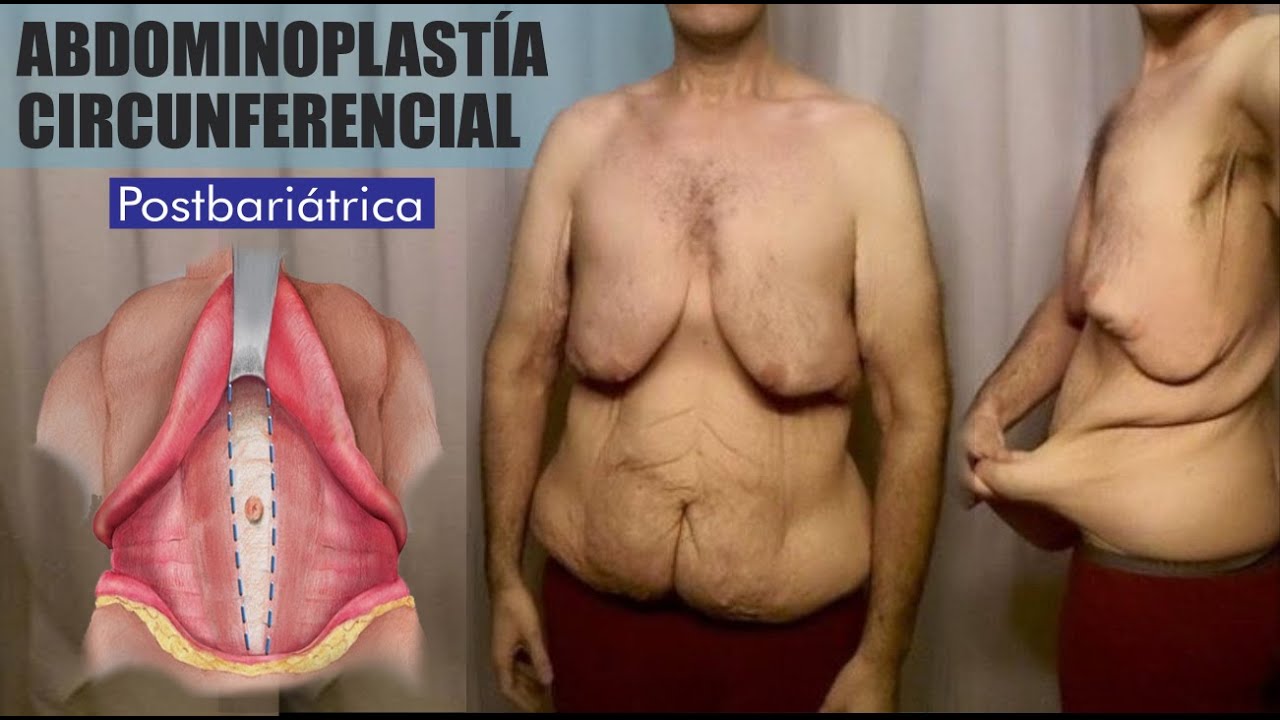 Adominoplastía CIRCUNFERENCIAL 🔥 Postbariátrica 👙 ¿BAJASTE mucho de PESO? 🔴 Dr ALBERTO CALVO QUIROZ
