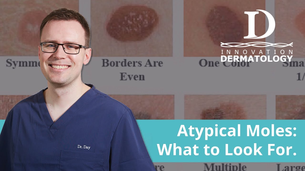 What is an Atypical Mole Ask Dr Day