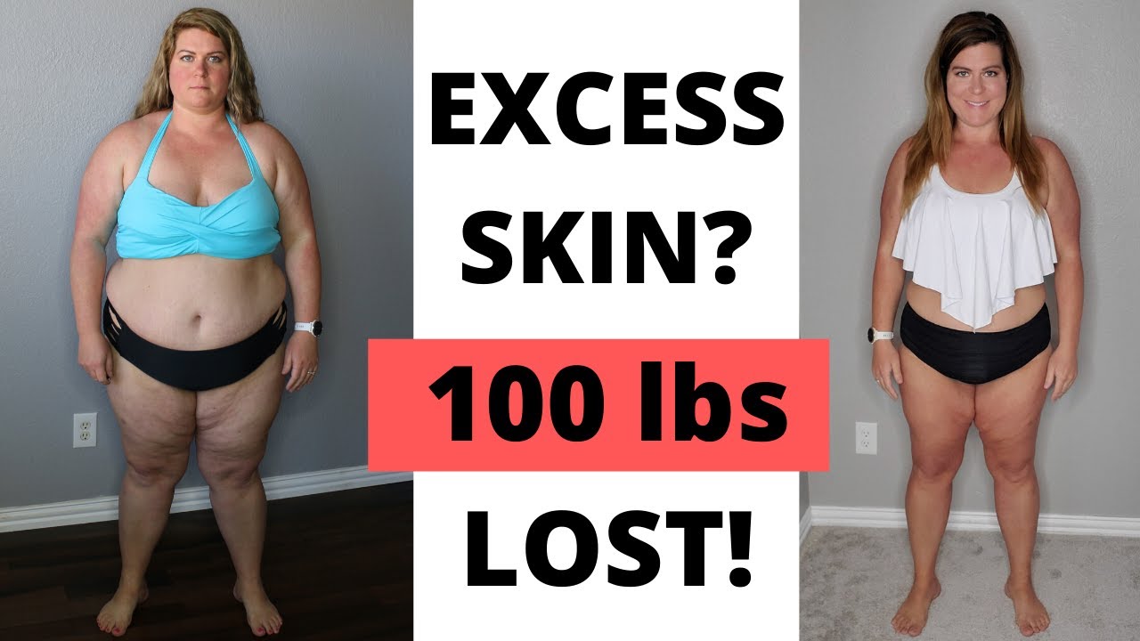 Week 48 Keto Transformation │Excess Skin After 100 Pound Loss?