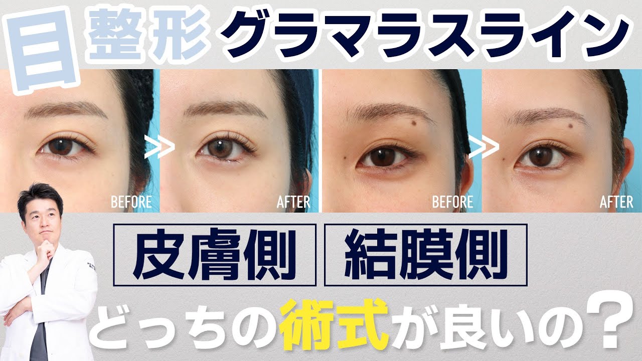 【整形】グラマラスライン（タレ目形成）について徹底解説いたします｜ヴェリテクリニック