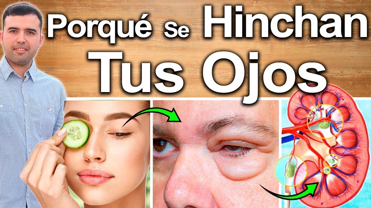 Porqué Se Hinchan Tus Ojos? - Causas Y Enfermedades Que Producen Ojos Hinchados