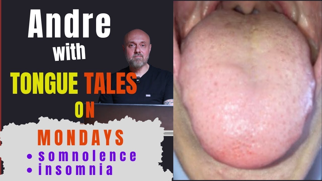 TONGUE TALES ON MONDAY: somnolence and insomnia