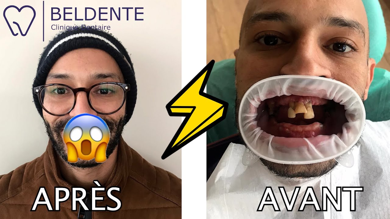 DENTS AVANT/APRÈS, INCROYABLE