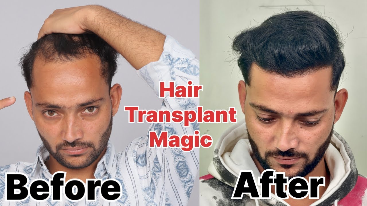 Junaid’s Hair Transplant Result Journey | day by day Hair Transplant Journey 