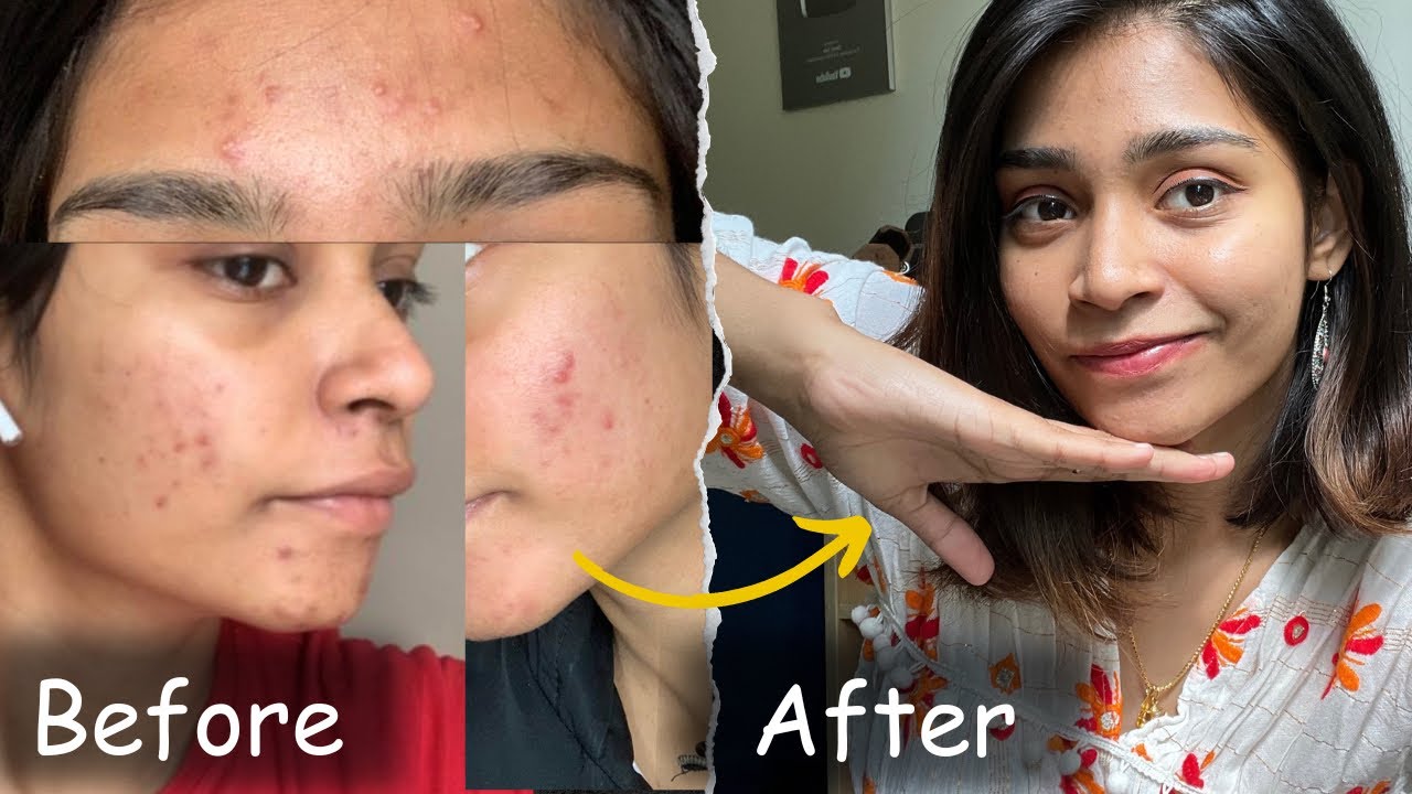 This Changed my life….! | No product | No doctor | Acne journey Tamil