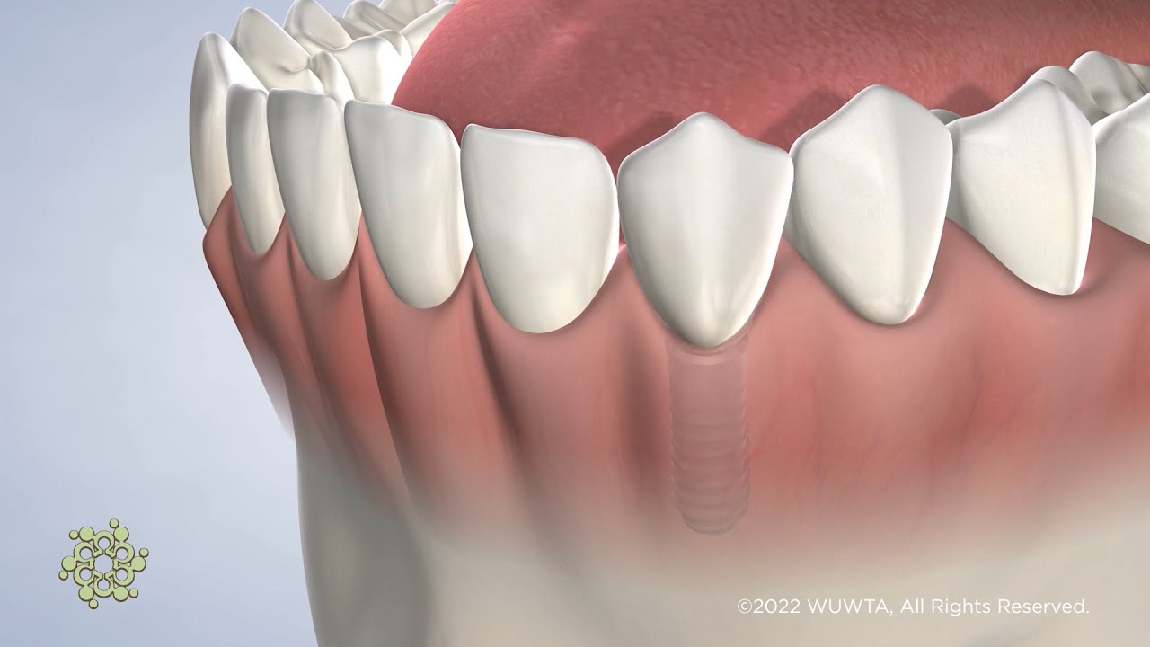 Dental Implants with Dr. Lieblick at Beacon Oral & Maxillofacial Surgeons