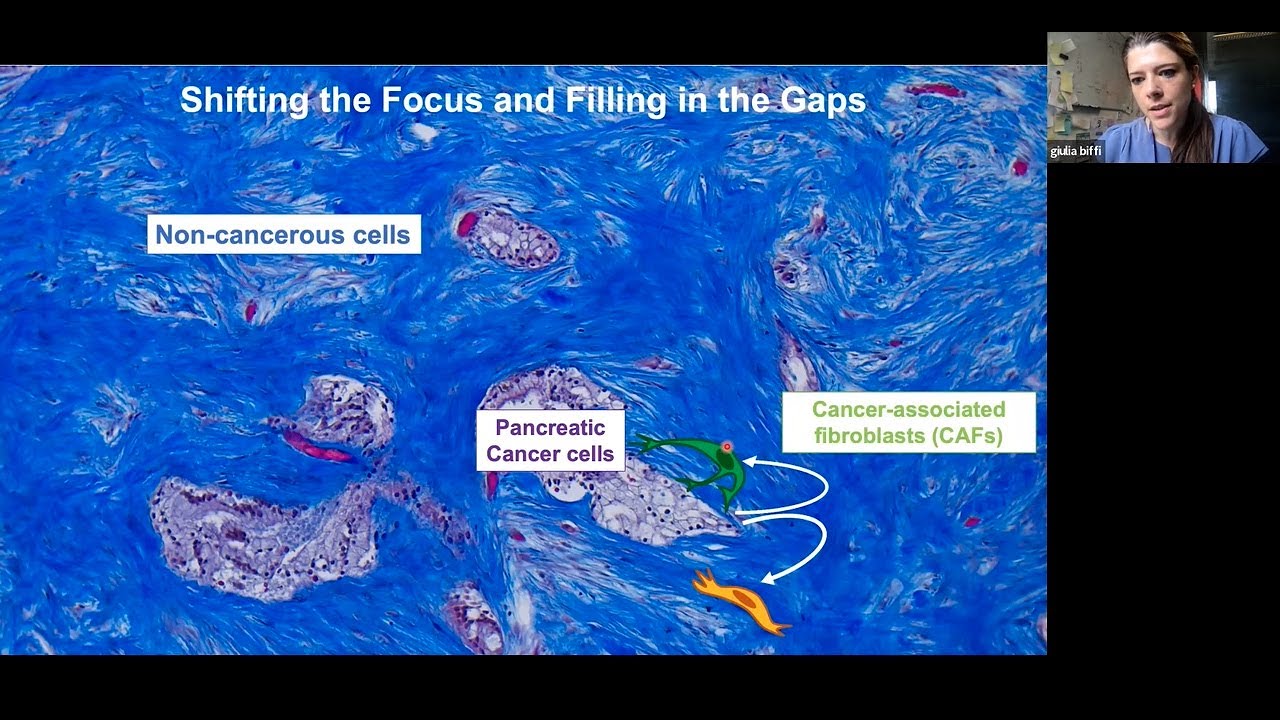 It takes a village: targeting the non-cancerous neighbours to fight pancreatic cancer