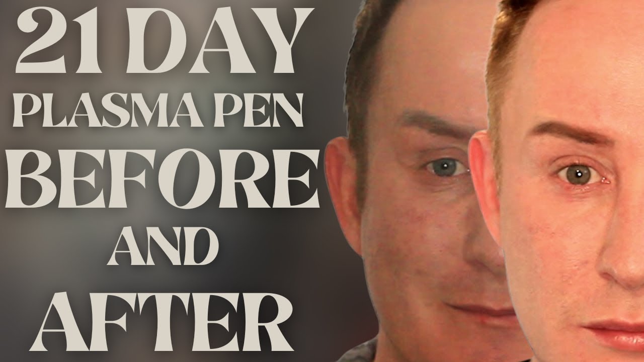21 Day Plasma Fibroblast Therapy Eyelid Tightening & Lift w/ Before & After Results