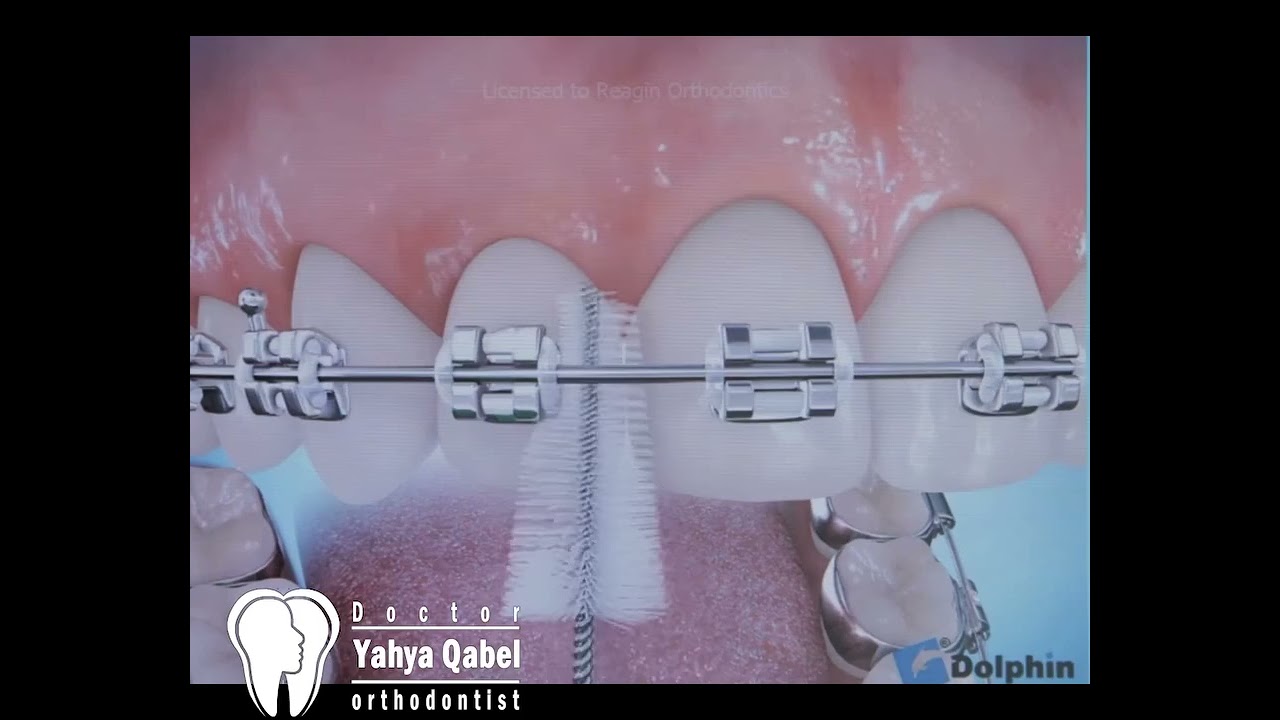 Congratulations on your braces! Here's the correct way to care for your oral health.