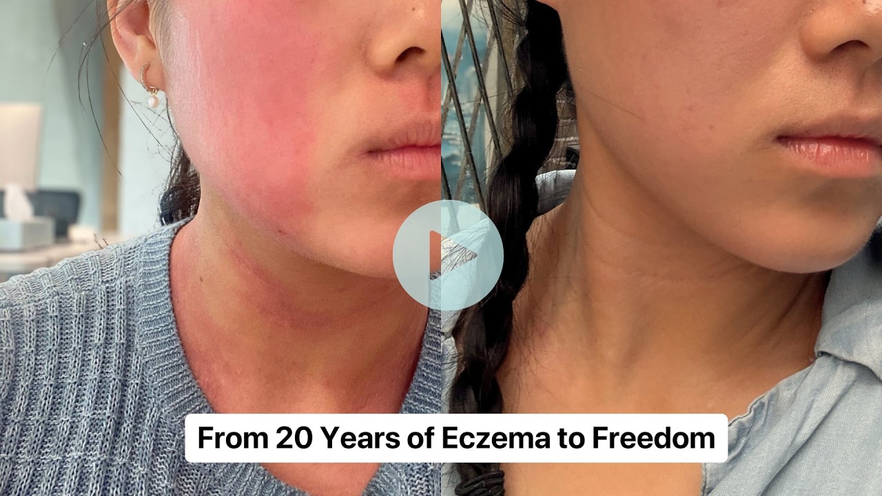 Eczema Healing After Immunosuppressants Failed (Simone's Root Cause Journey)