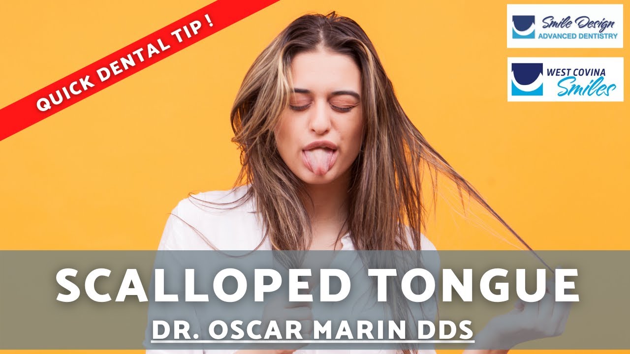 Scalloped Tongue