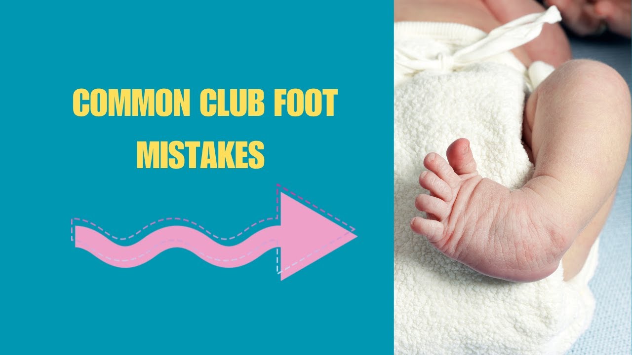 Common Club Foot Mistakes Parents Make | Do This Instead. Stretches To Correct Club Foot.