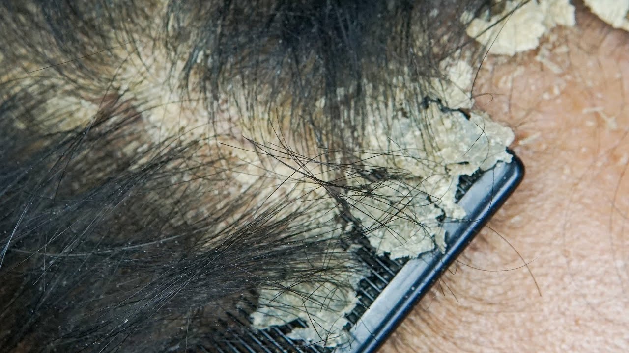 ASMR Scalp Treatment Dandruff Removal | Satisfying Extraction & Calm #48