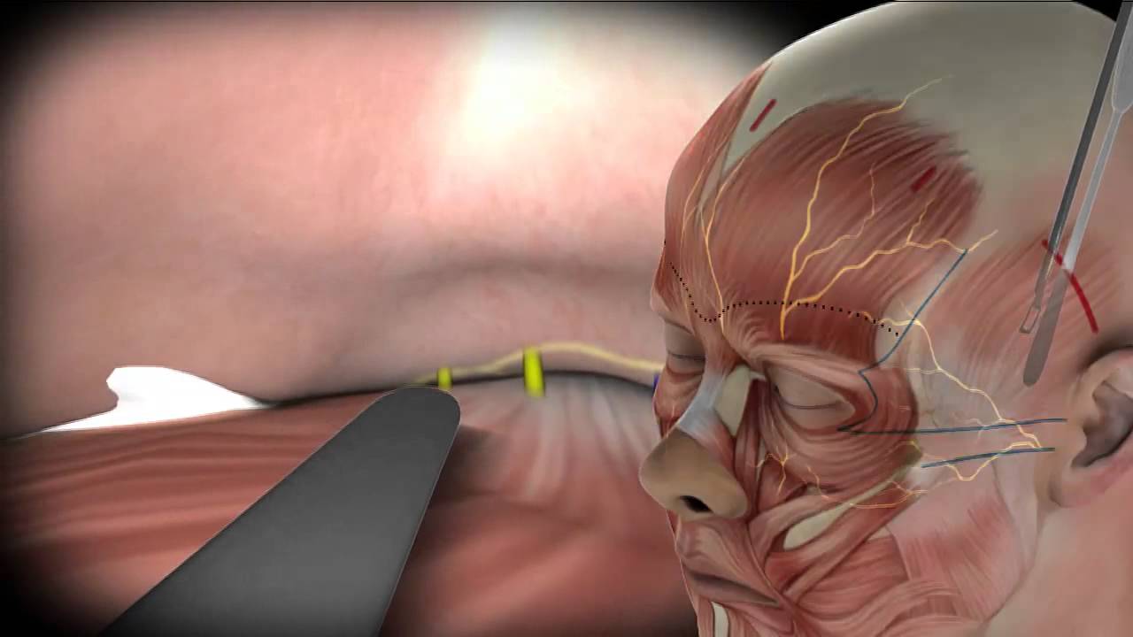 Endoscopic Face Lift: MIVEL by Alessandro Gennai [technique]