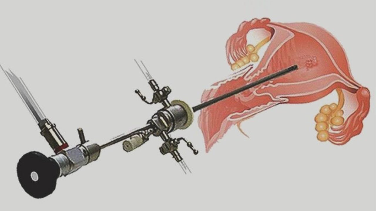 Kiçik uşaqlıq hamiləliyə mane olur?