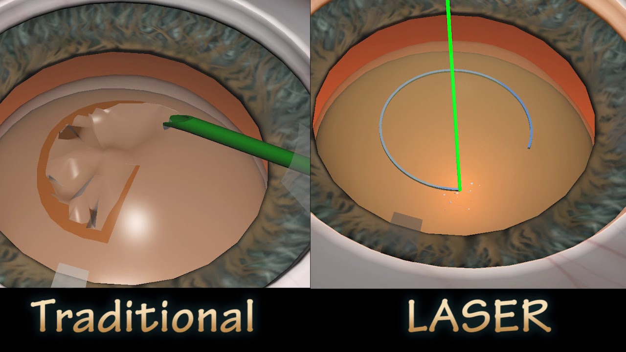 FLACS VS TRADITIONAL CATARACT SURGERY -  Rhexis Compare