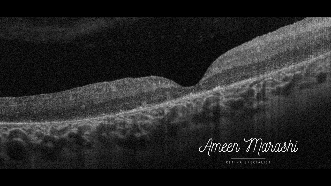 Course in clinical applications of OCT for macular diseases - Hereditary diseases
