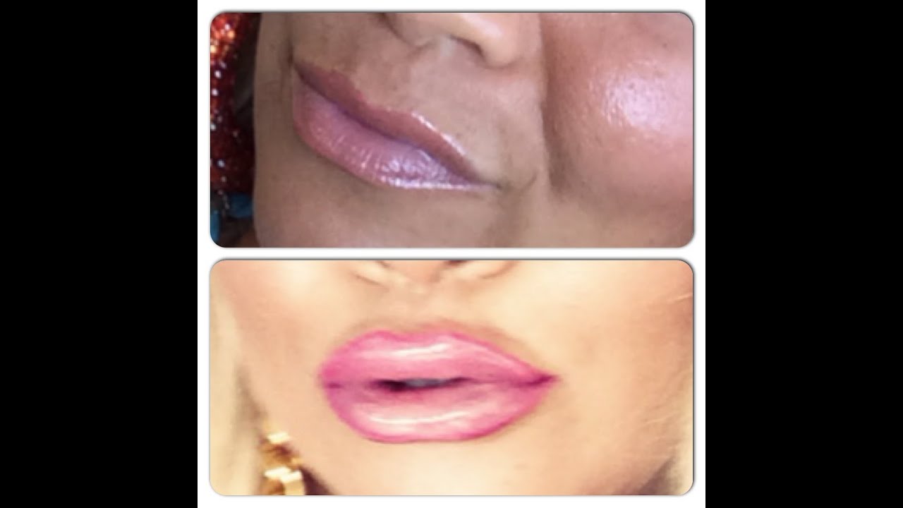 All About My Lip Injections!