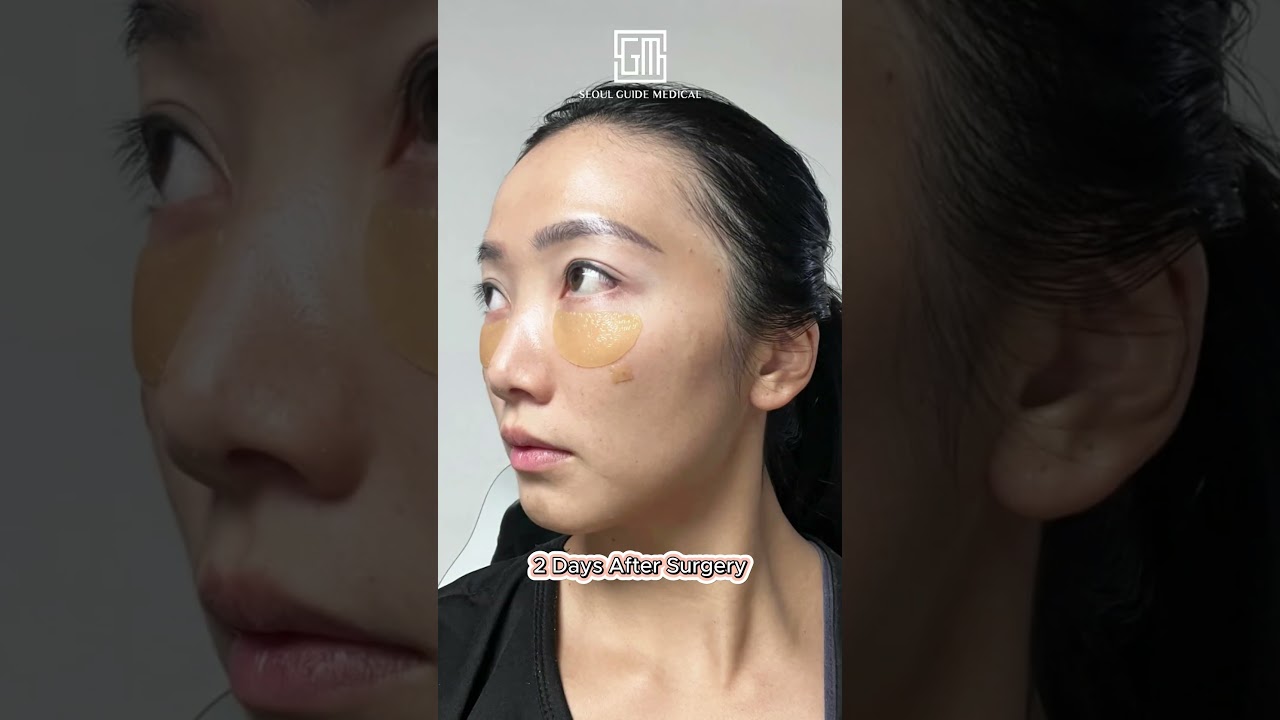 7 Days After Surgery of Fat Grafting 👀