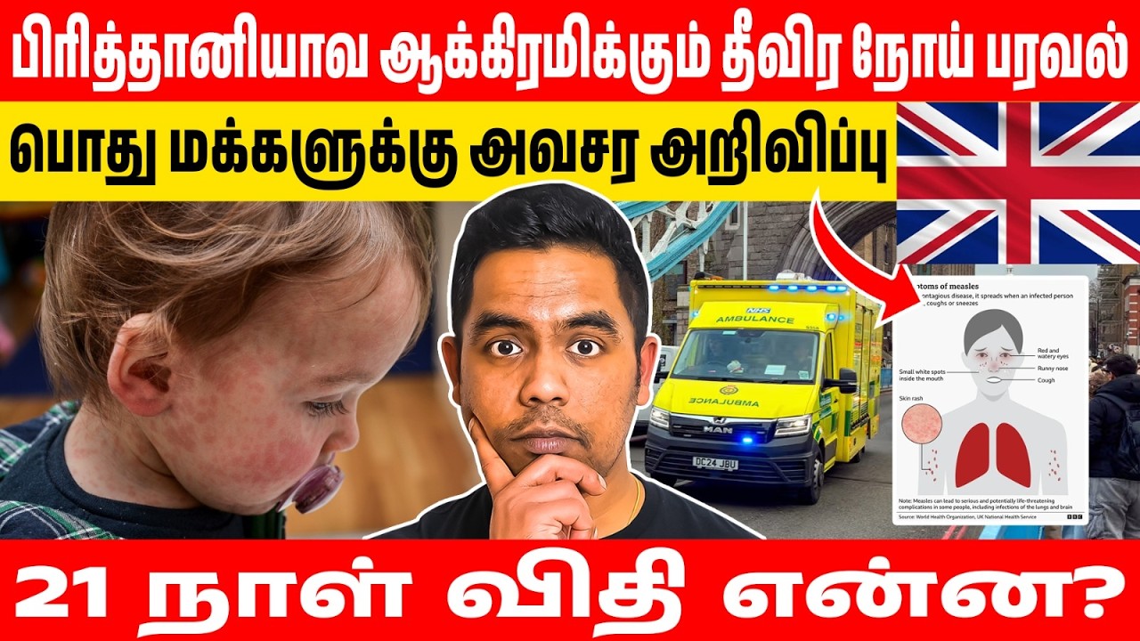 பிரித்தானியாவில் அவசர நிலை! 📉 தட்டம்மை பாதிப்பு தீவிரம் - Enfield பகுதியில் அதிரடி நடவடிக்கை!