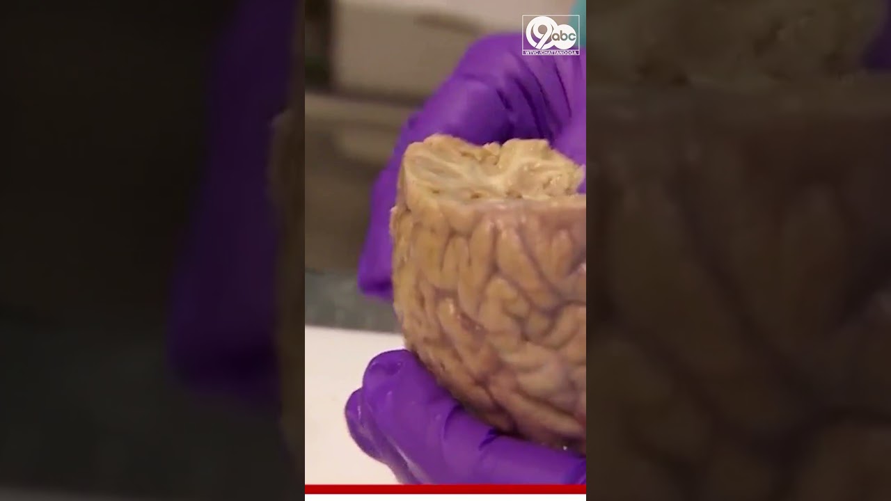 New study finds surprising levels of plastic in the human brain