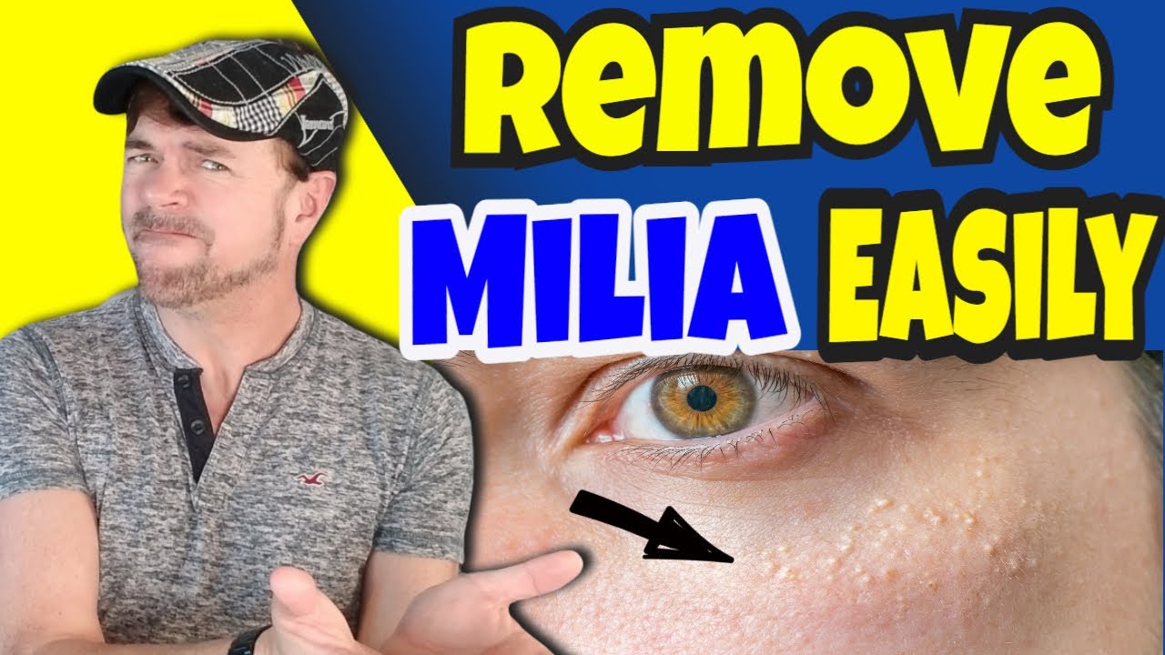 Get Rid Of Hard White Skin Bumps on the Face (Milia) | #shorts