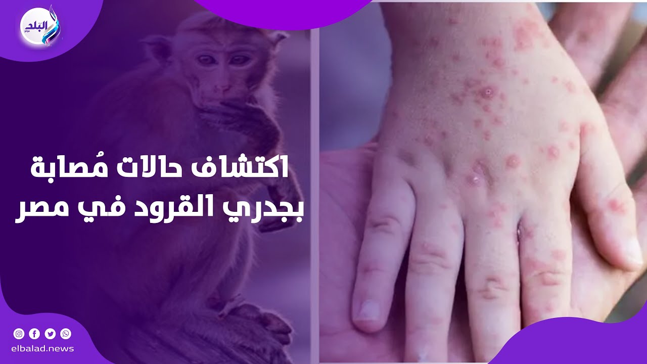 تعطيل الدراسة والعمل من المنزل .. ماذا سيحدث حال انتشار فيروس جدري القرود ؟!