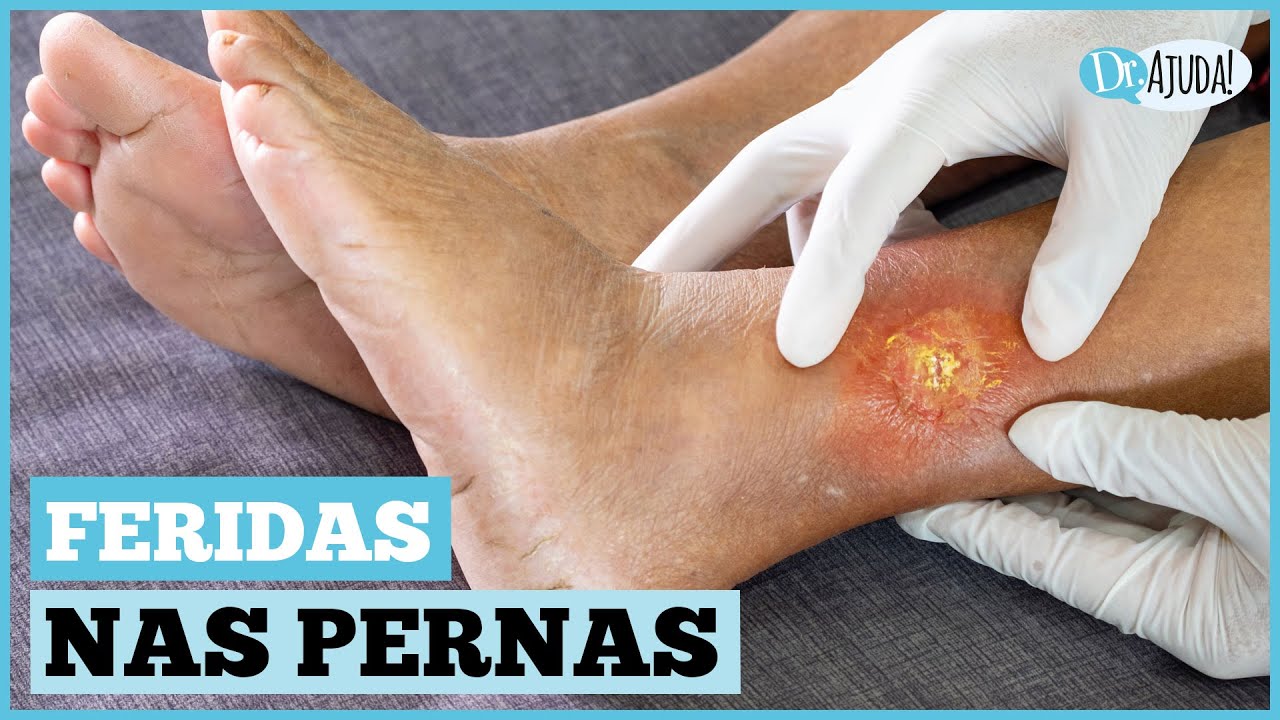 QUAIS AS CAUSAS DE FERIDAS NAS PERNAS E NOS P&Eacute;S? O QUE FAZER ?