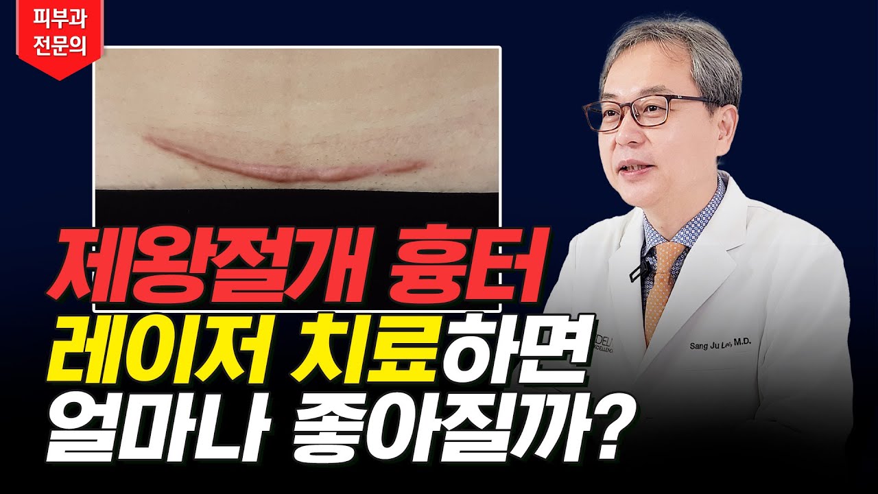 제왕절개 흉터 확실하게 없애는 법 ❗❗ 피부과 전문의가 알려드립니다👨🏻&zwj;⚕️