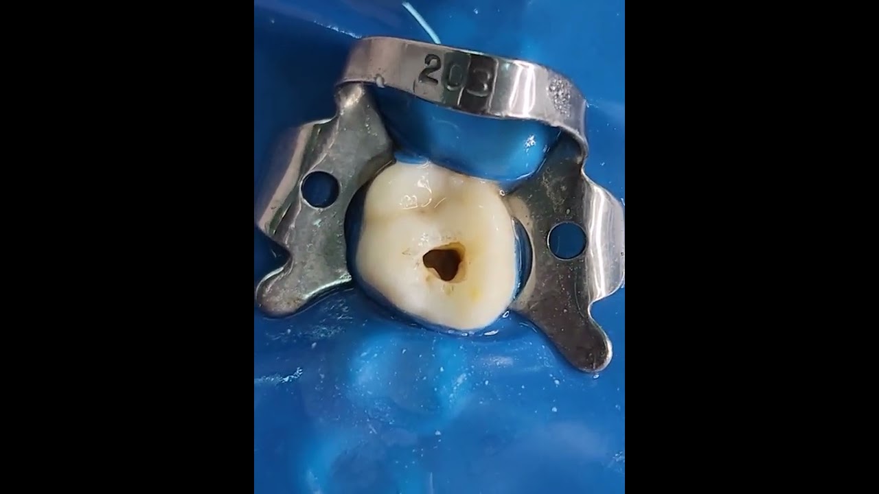 Access Cavity Preparation of Maxillary First Molar