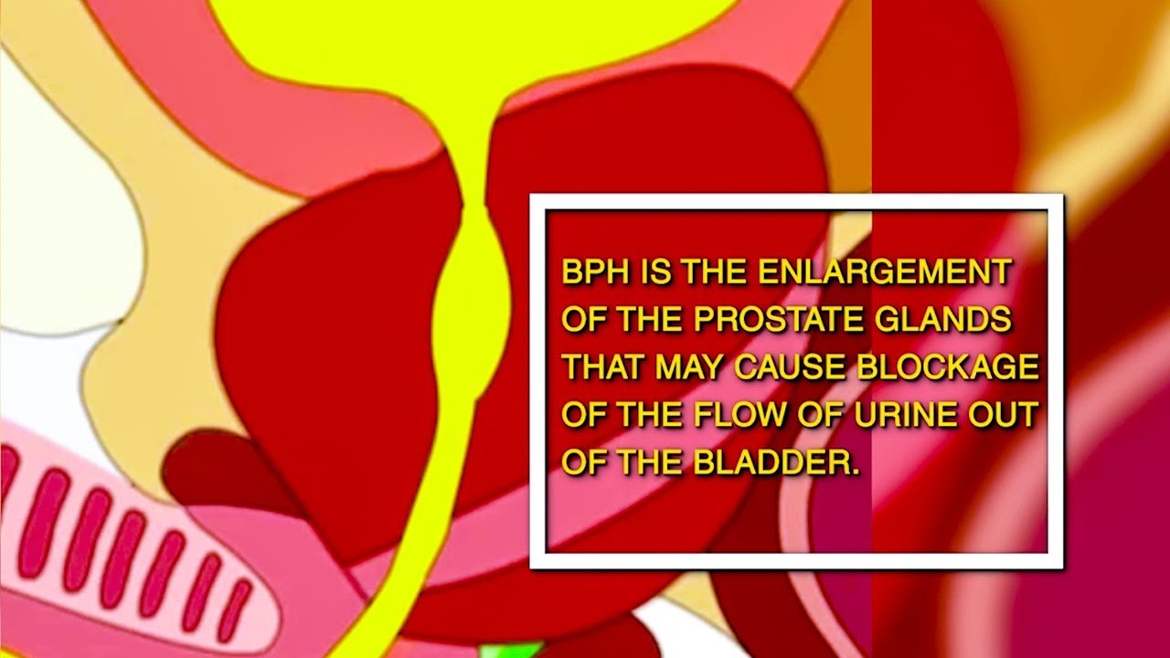 Thulium laser prostatectomy machine | Usapang Pangkalusugan