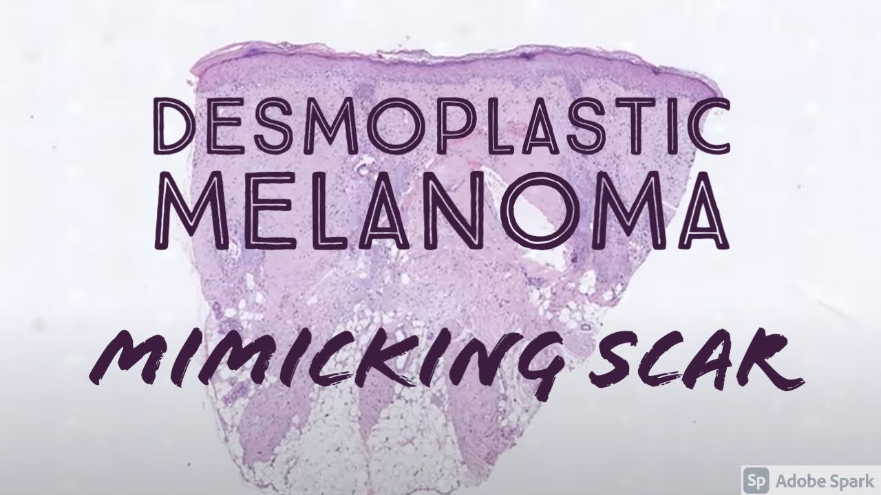 Desmoplastic melanoma mimicking scar (Clue: pink collagen replacing blue solar elastosis)