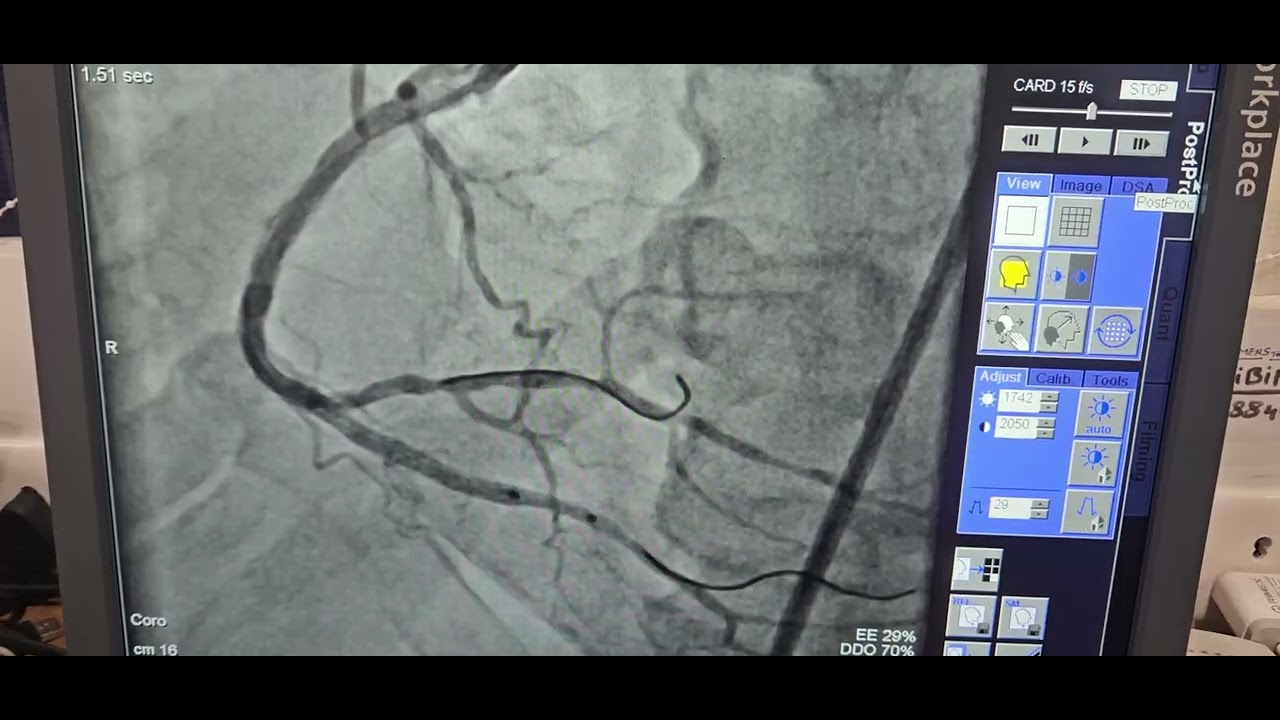 TAP technique- RCA bifurcation stenting