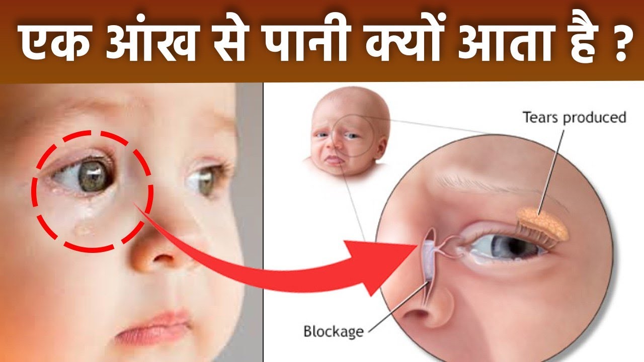 Baby One Eye Watering Reason In Hindi, Treatment क्या है|बच्चे के 1 आंख में पानी आने का कारण|Boldsky