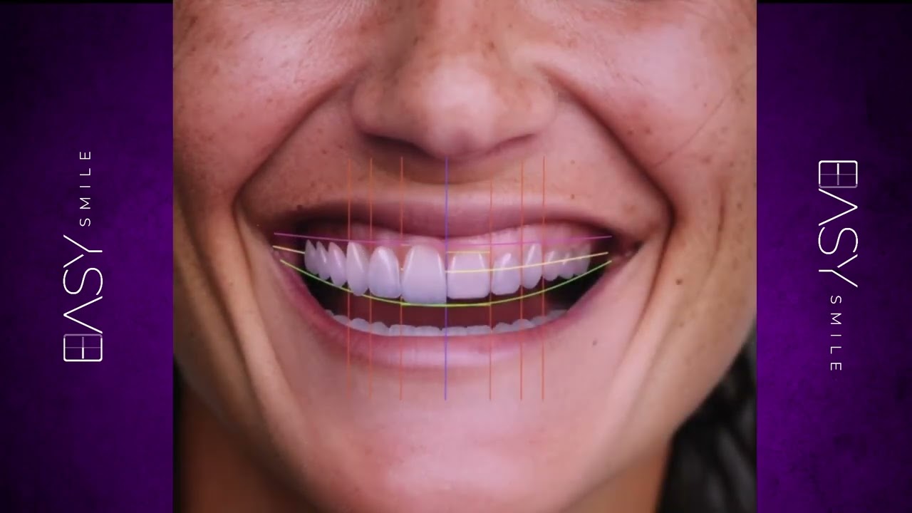 Design de sorriso Easy Smile para paciente que precisa de plástica gengival.