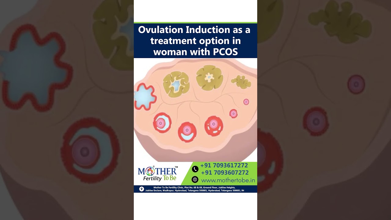 Ovulation Induction for Women with PCOS || MotherToBe