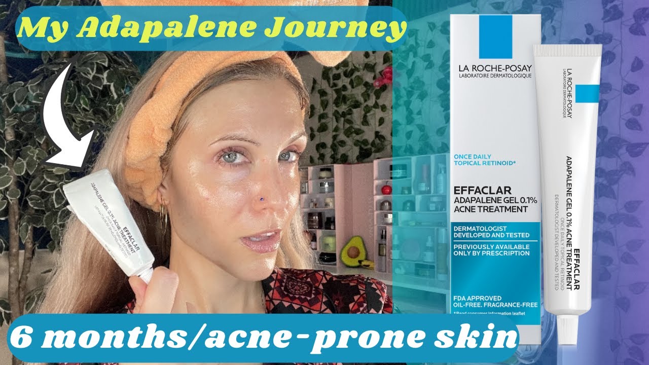 I did it!! 6 Months of Adapalene (acne-prone skin)