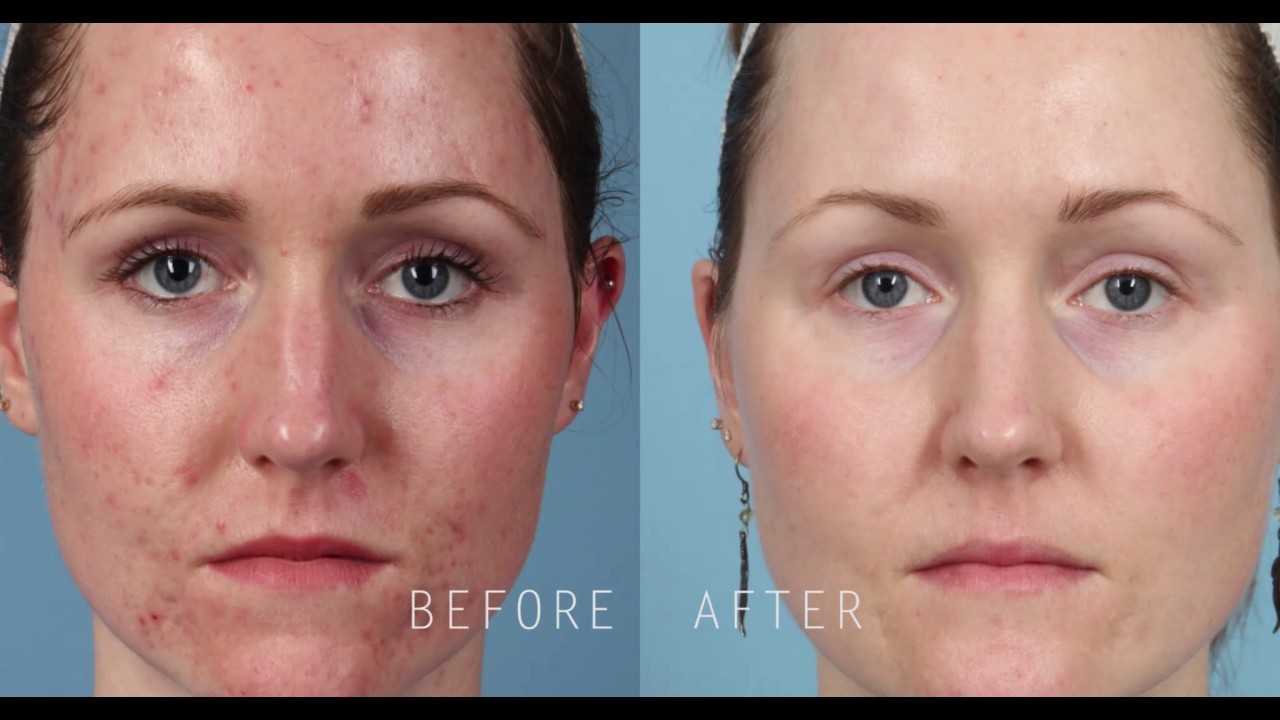 PicoSure Focus Skin Rejuvenation for Treatment of Acne Scars