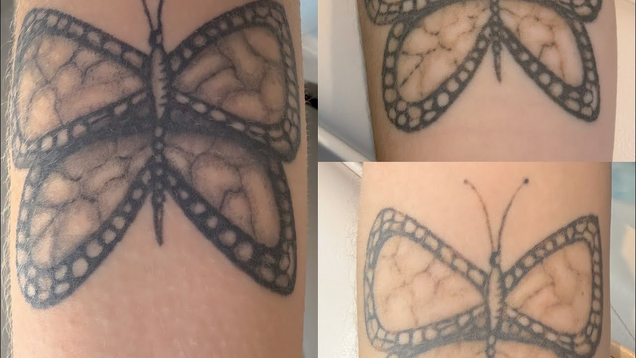 Laser Tattoo Removal - Large Black Butterfly Full version CLC Teneriffe 