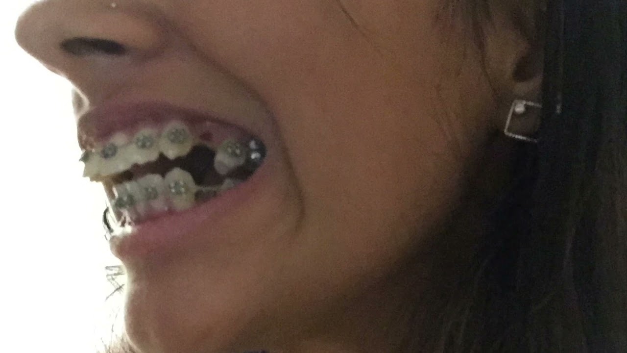 Braces journey