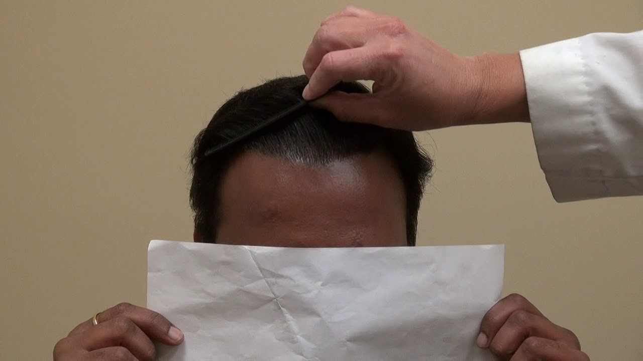 Hair Transplant 10th Month Follow Restoration Surgery Progress by Dr. Diep Bald Hair Loss Treatment