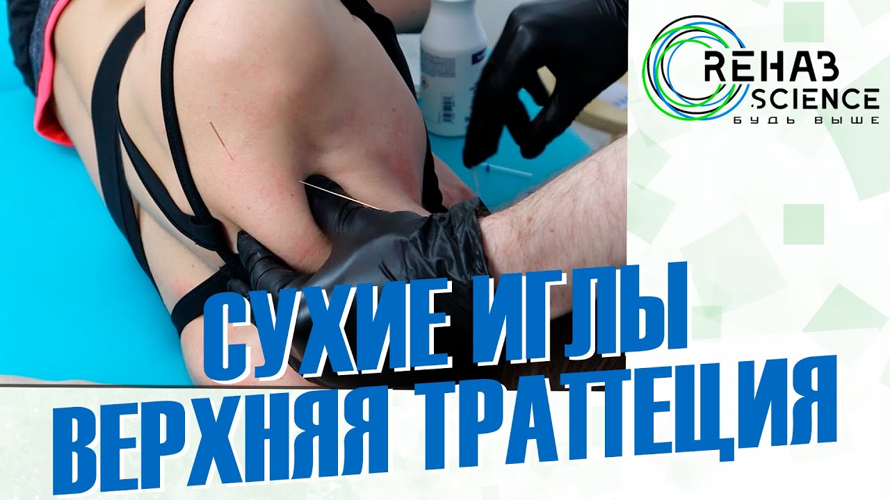 Метод сухой иглы. Расслабление шеи.