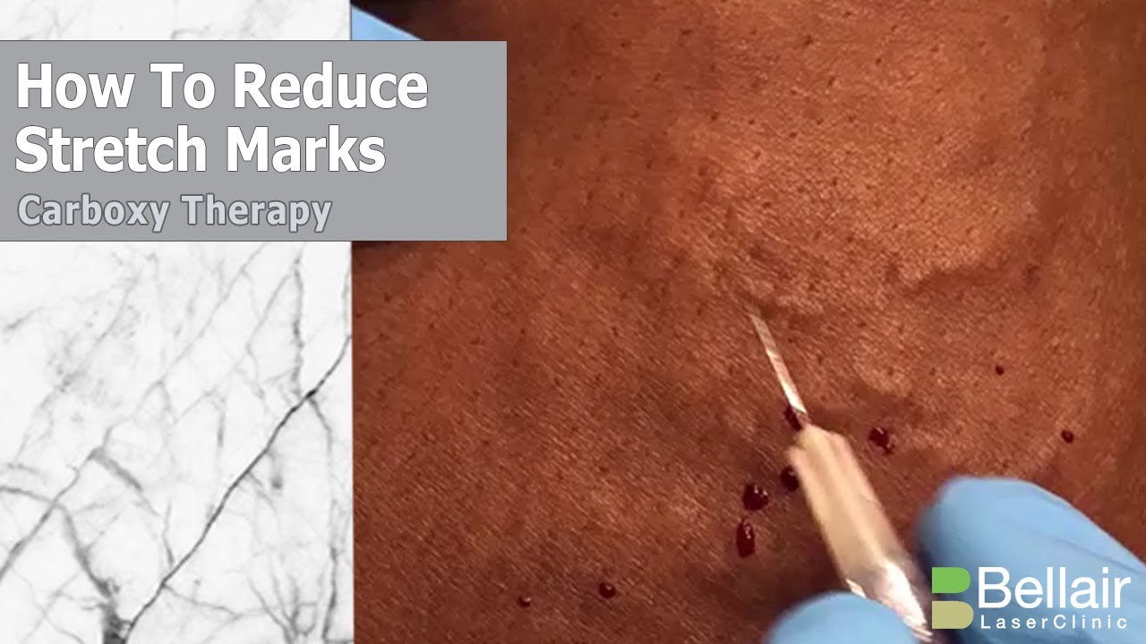 How does carboxytherapy stretch mark treatment work?