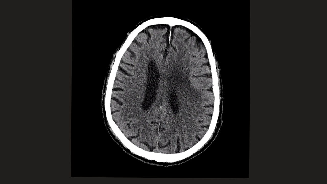 Intra-axial vs Extra-axial brain lesions: Can you tell the difference?