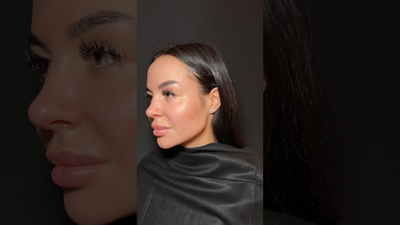 Jawline contouring💉 #lifting #lipfiller #botox #fullface #lips #filler #jawline #beauty #contouring