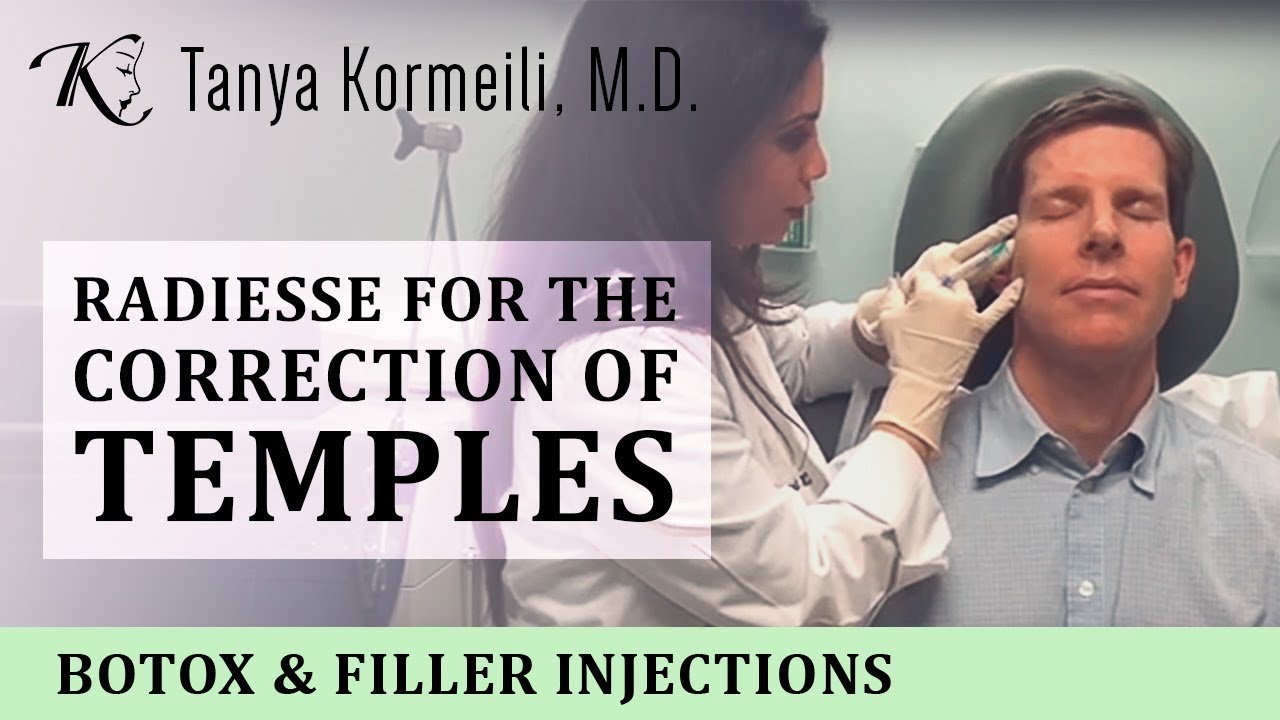 Radiesse for the correction of temples