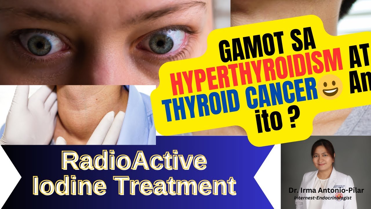 RADIOACTIVE IODINE TREATMENT: GAMOT SA HYPERTHYROIDISM AT THYROID CANCER😀 Ano ito?
