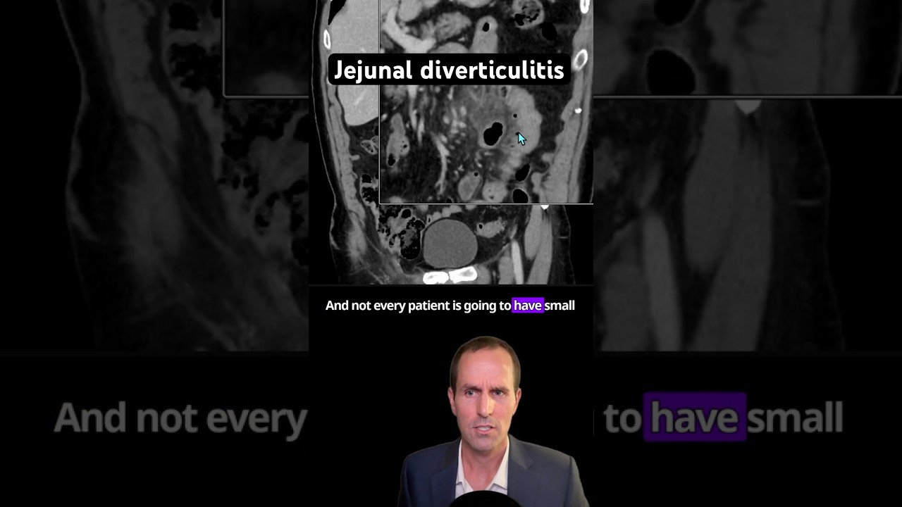 Abdominal CT Tutorials - Jejunal diverticulitis